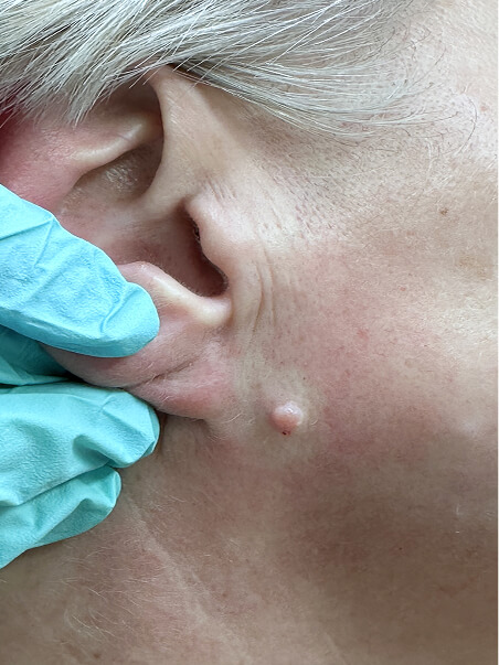 Mole Diagnosis, Biopsies &amp; Removal treatment in action
 before result