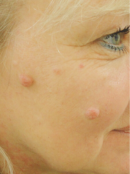 Mole Diagnosis, Biopsies &amp; Removal treatment in action
 before result