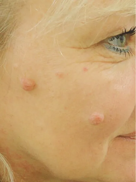 Mole Diagnosis, Biopsies &amp; Removal treatment in action
 before result