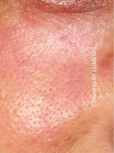 CO2 Resurfacing treatment in action
 after result