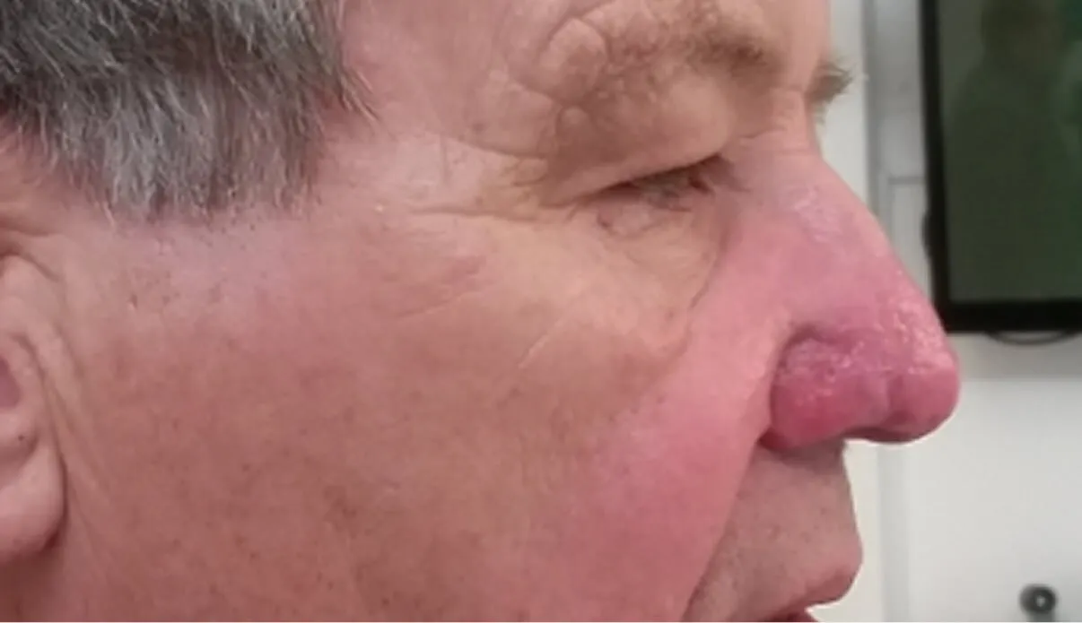 Post-Treatment Care