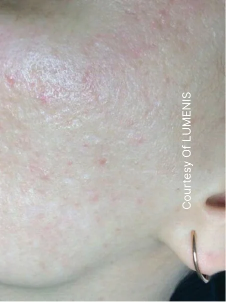 CO2 Resurfacing treatment in action
 after result