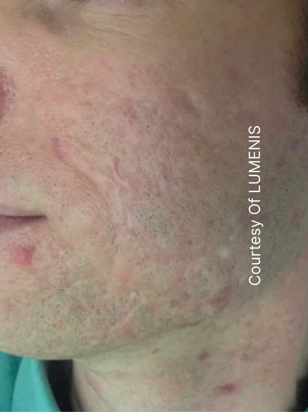 CO2 Resurfacing treatment in action
 after result