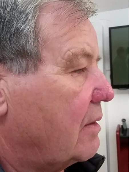Rhinophyma treatment in action
 after result