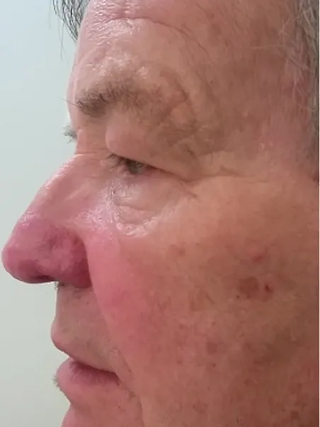 Rhinophyma treatment in action
 after result