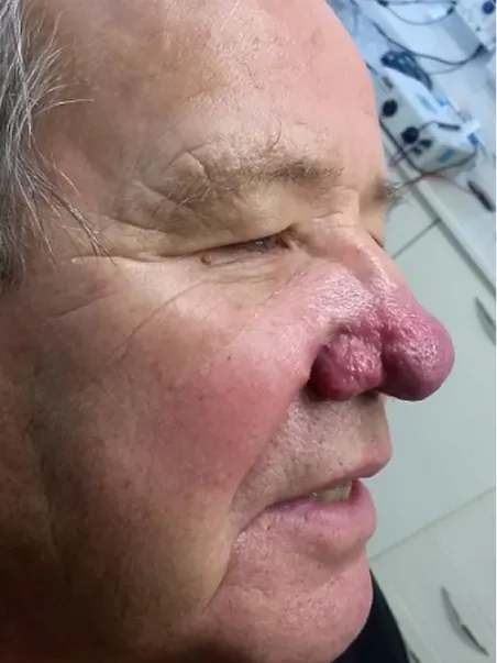 Rhinophyma treatment in action
 before result