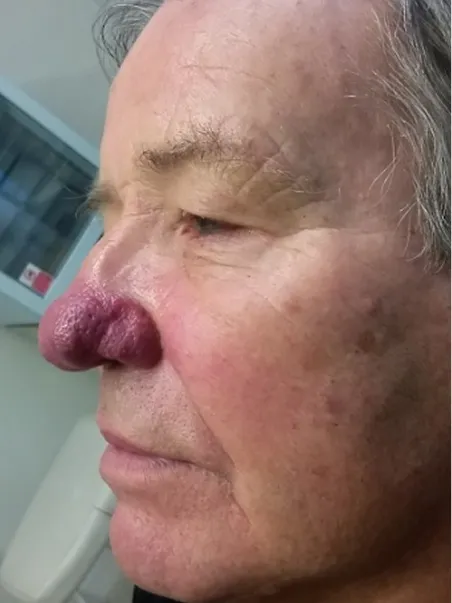 Rhinophyma treatment in action
 before result