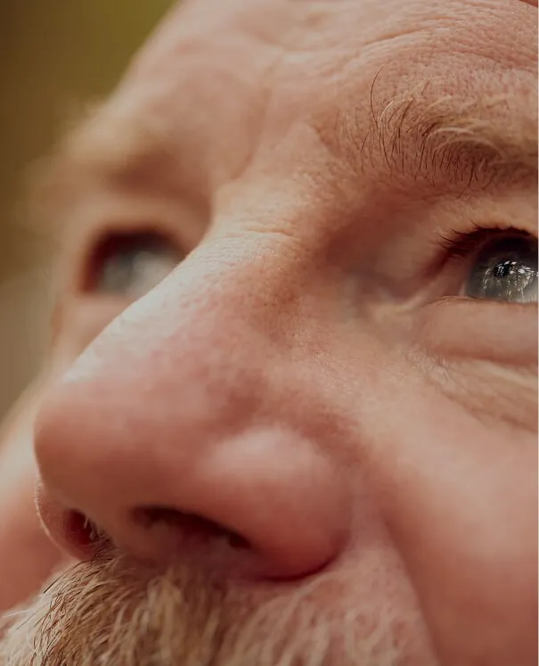 Rhinophyma small Rhinophyma - rtwskin clinic