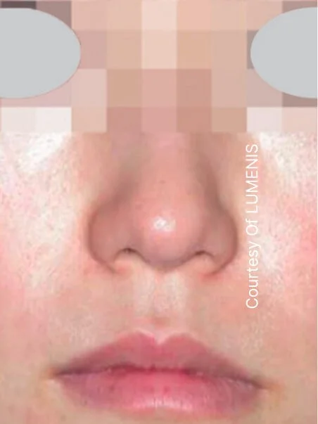 Rosacea treatment in action
 after result