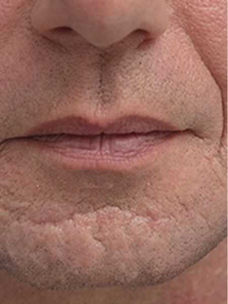 Scar Revision treatment in action
 after result