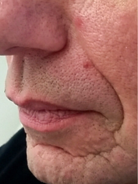 Scar Revision treatment in action
 before result
