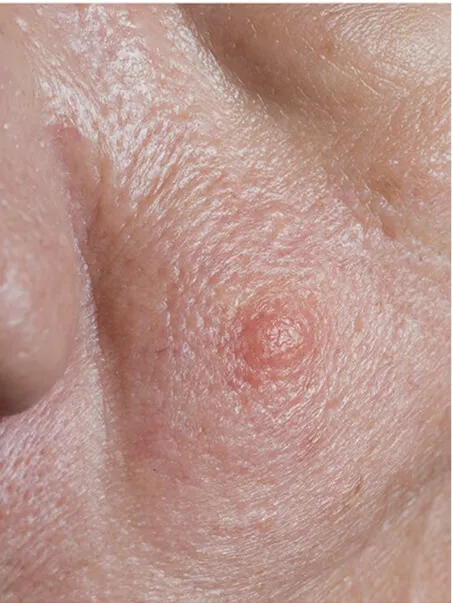Sebaceous hyperplasia (1) Sebaceous hyperplasia - rtwskin clinic