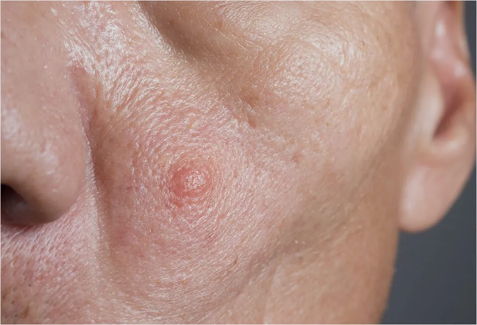 Sebaceous hyperplasia