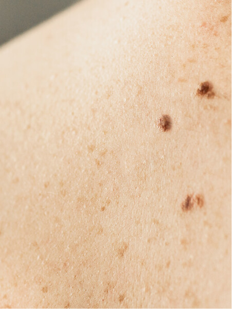 Seborrheic Keratosis