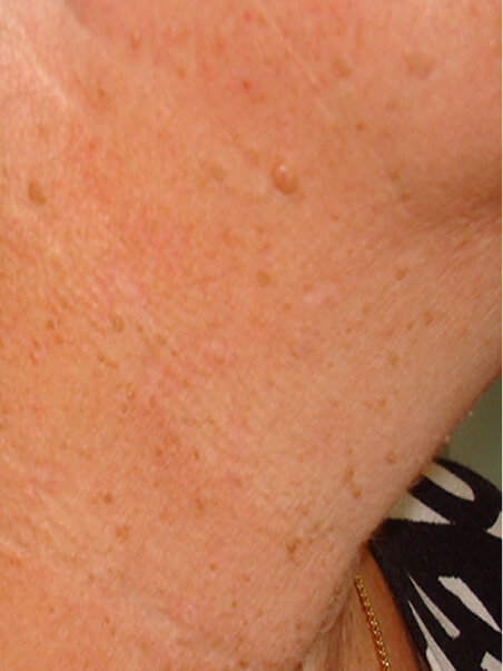 Skin Tag treatment in action
 after result