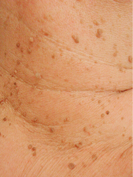 Skin Tag treatment in action
 before result