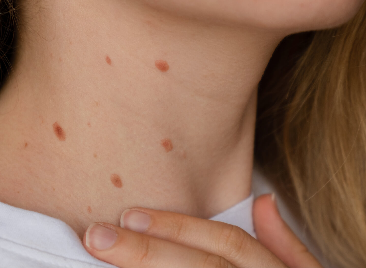 Skin Tag