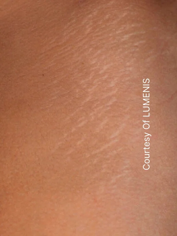 CO2 Resurfacing treatment in action
 before result