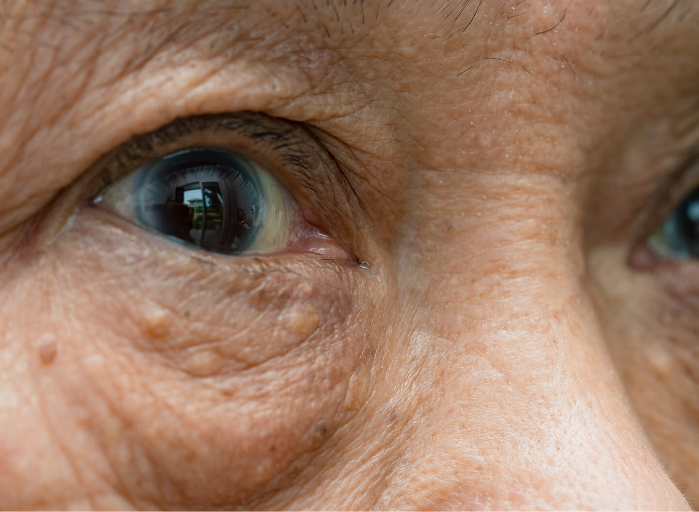 Syringoma