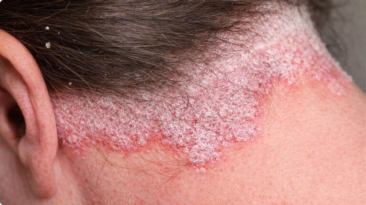 Treating Psoriasis on Face and Scalp
