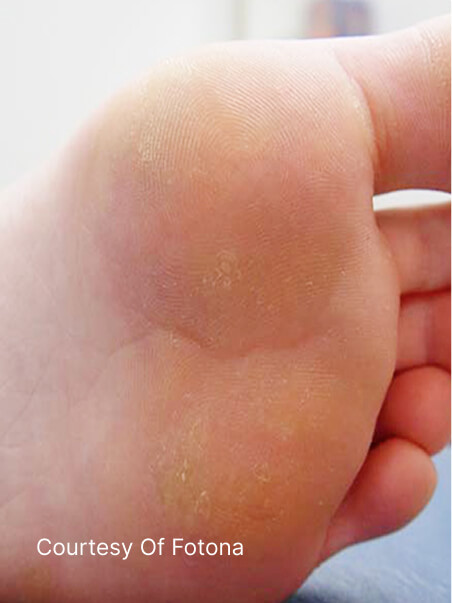 Wart and Verucca treatment in action
 after result