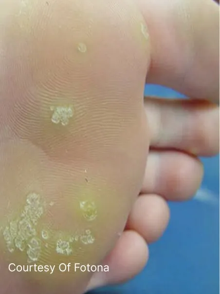 Wart and Verucca treatment in action
 before result