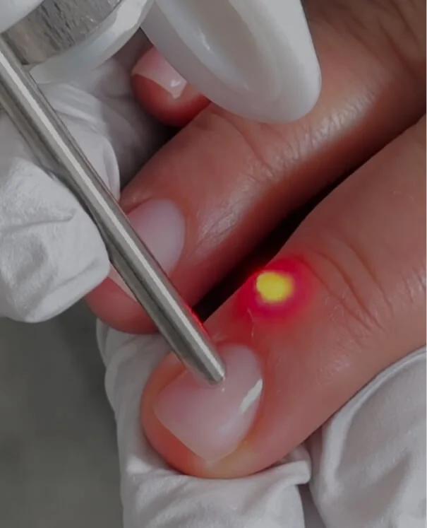 Wart and Verucca Wart and Verruca - rtwskin clinic