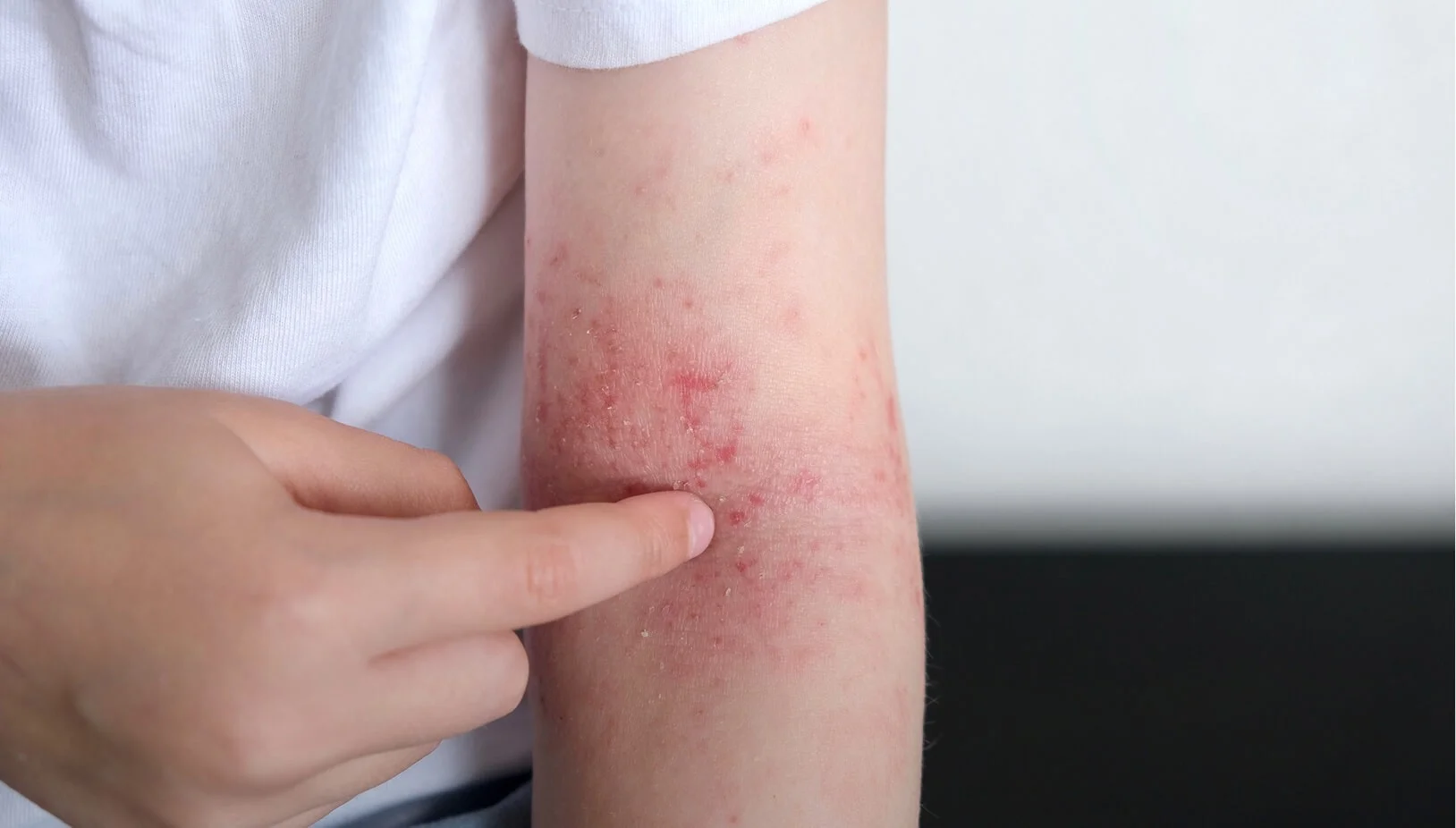 What Is Eczema?