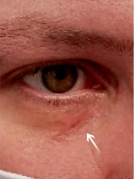 Xanthelasma treatment in action after result