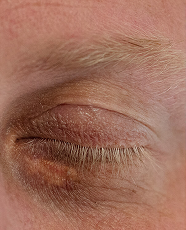 Xanthelasma