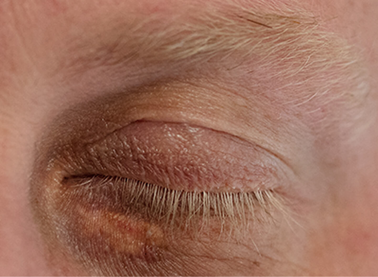 Xanthelasma