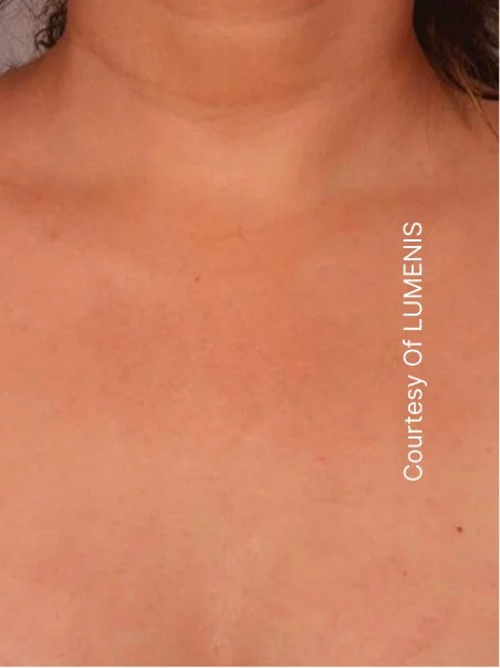 CO2 Resurfacing treatment in action
 after result