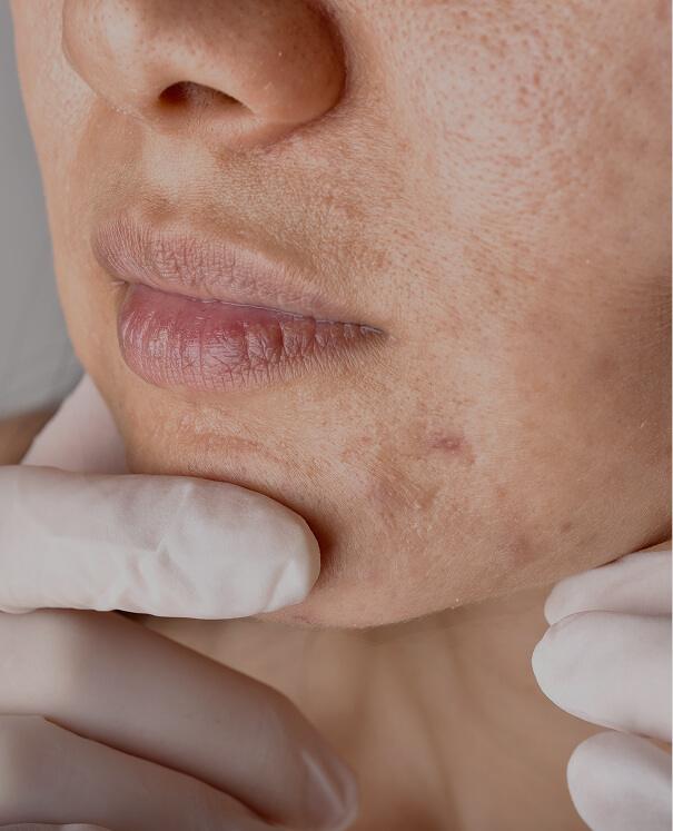 Acne scarring