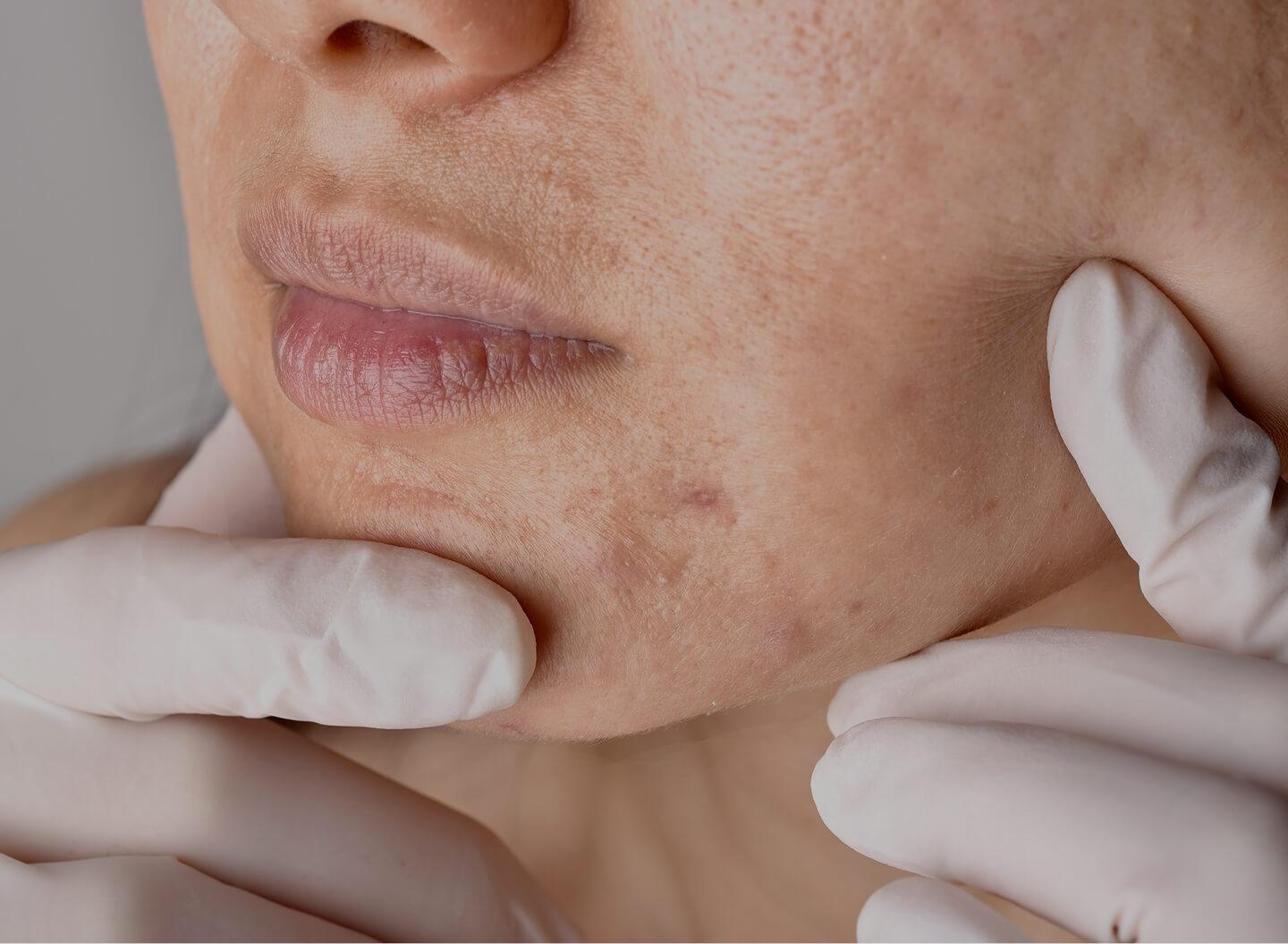 Acne scarring