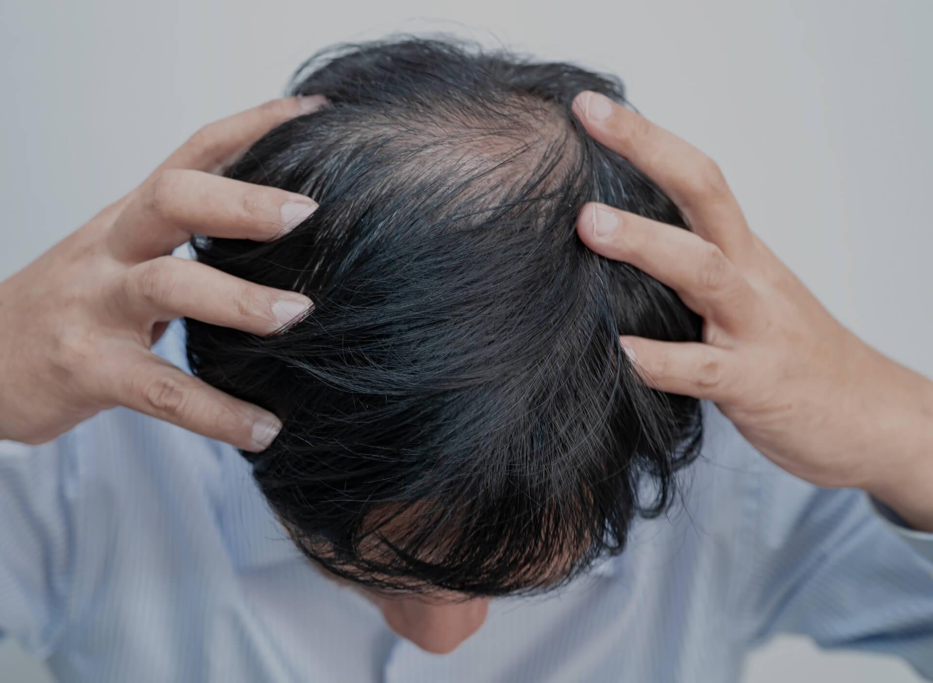 Alopecia