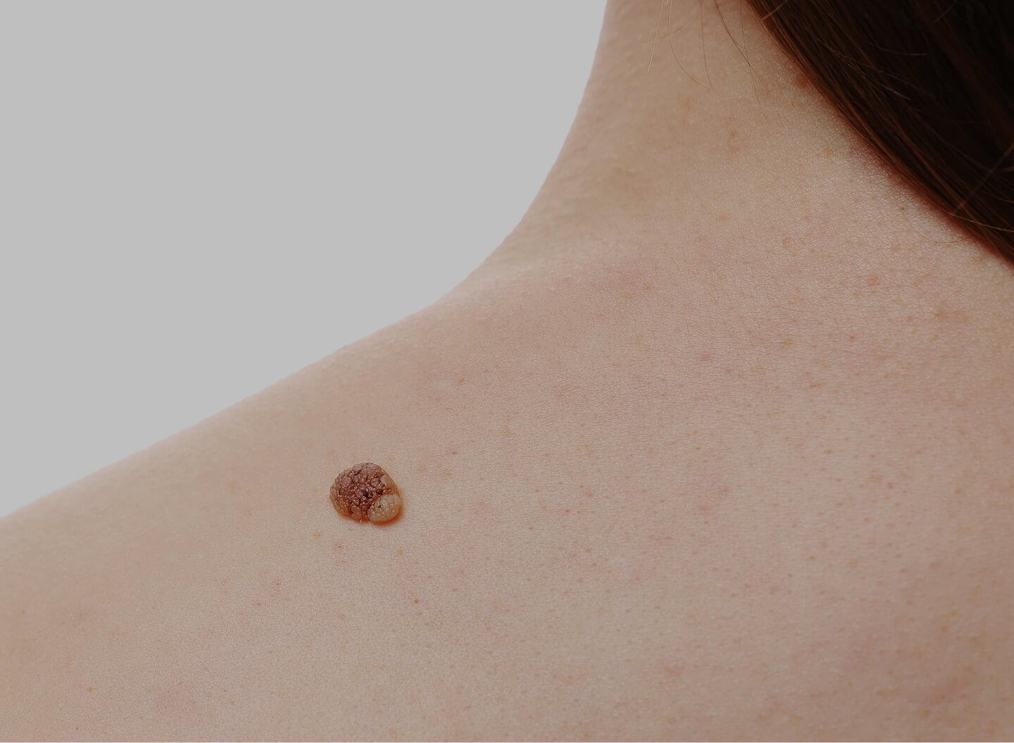 Birthmark