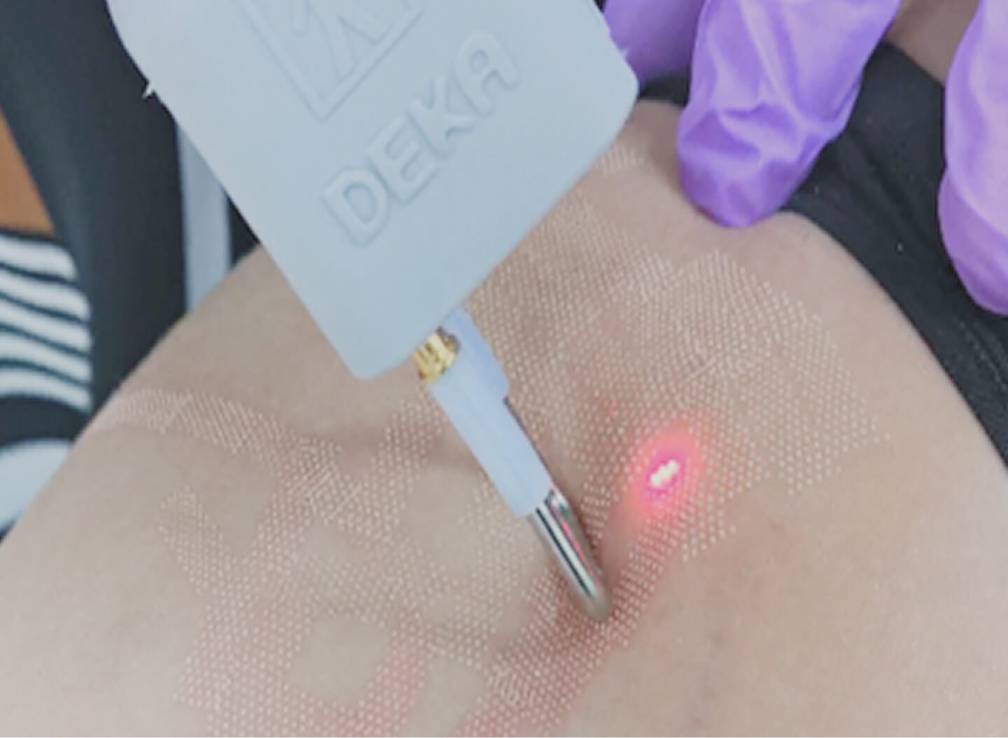 CO2 Laser Resurfacing
