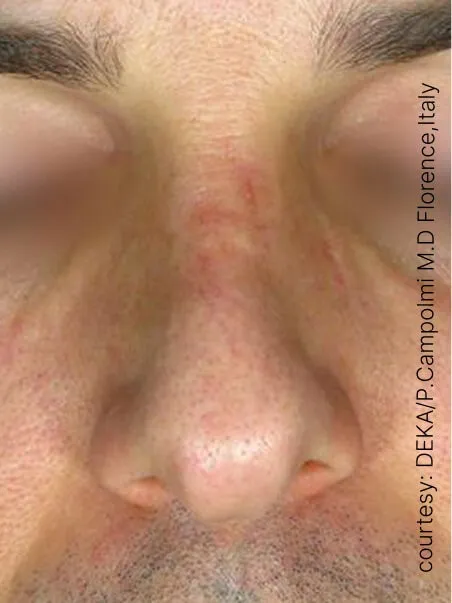 Rosacea treatment in action
 after result