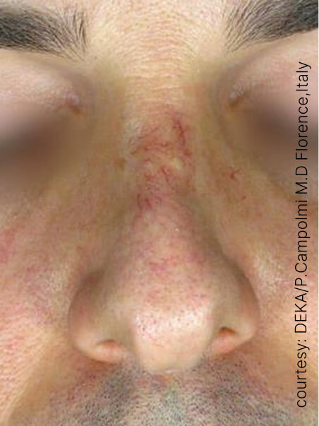 Rosacea treatment in action
 before result