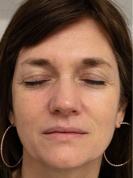 Dermapen treatment in action
 after result