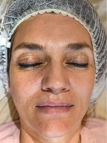 Dermapen treatment in action
 before result