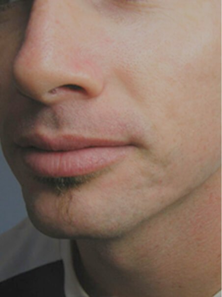 RF Microneedling &amp; Dermaroller treatment in action
 after result