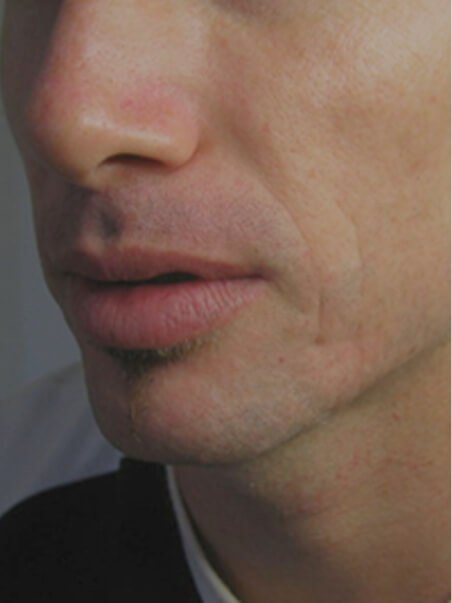 RF Microneedling &amp; Dermaroller treatment in action
 before result