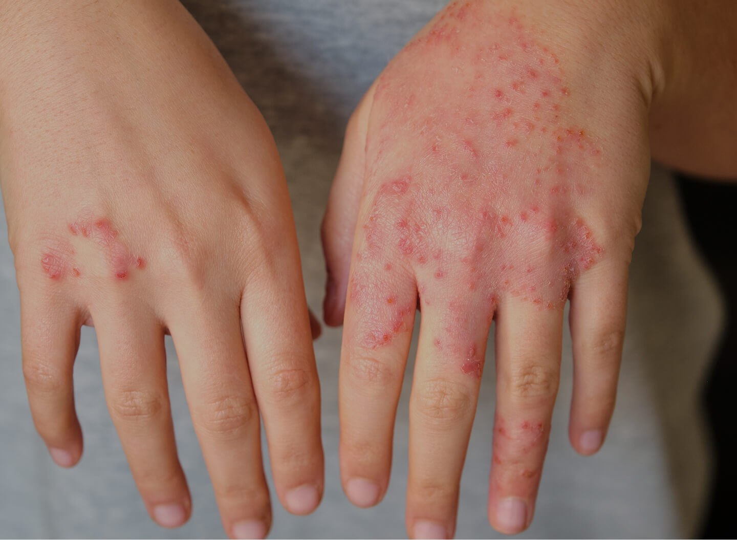 Eczema