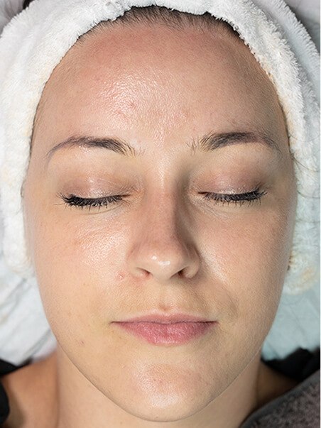 Chemical Peels treatment in action
 after result