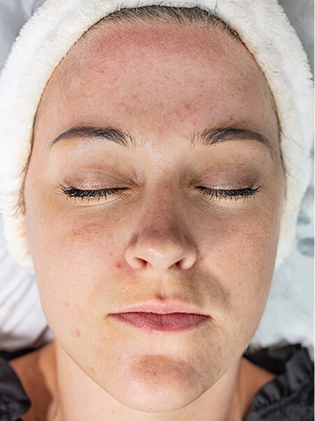Chemical Peels treatment in action
 before result