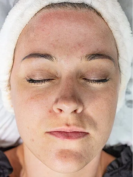 Chemical Peels treatment in action
 before result