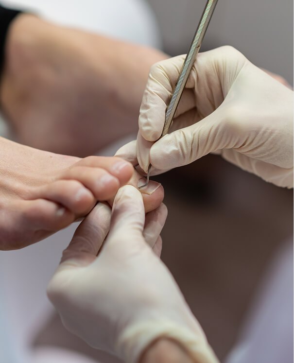Fungal Nail