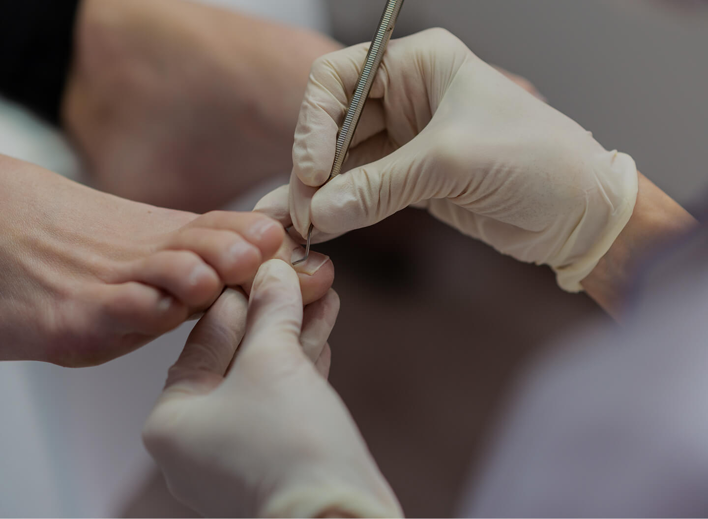 Fungal Nail