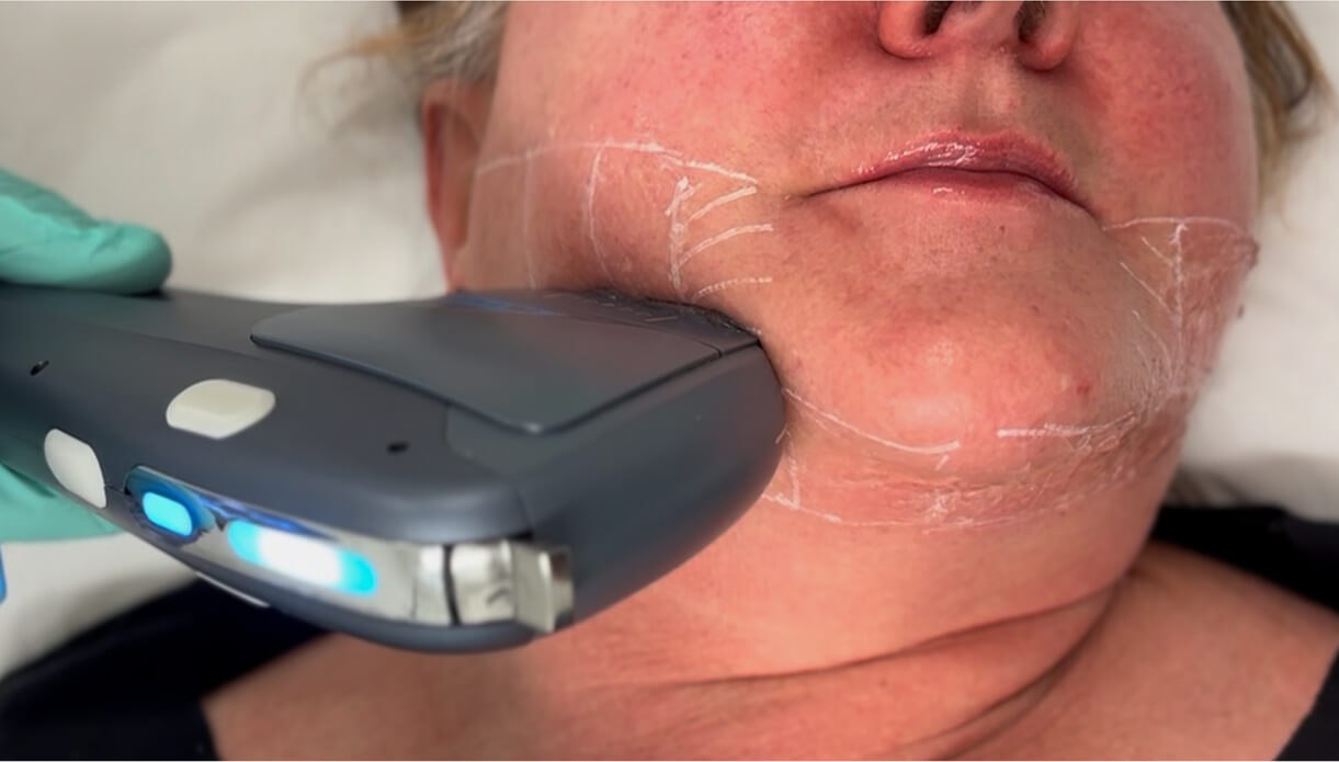 HIFU neck fat removal vs traditional methods rtwskin Is HIFU right for you?